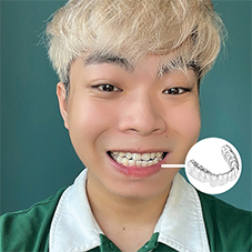 Niềng răng trong suốt Invisalign