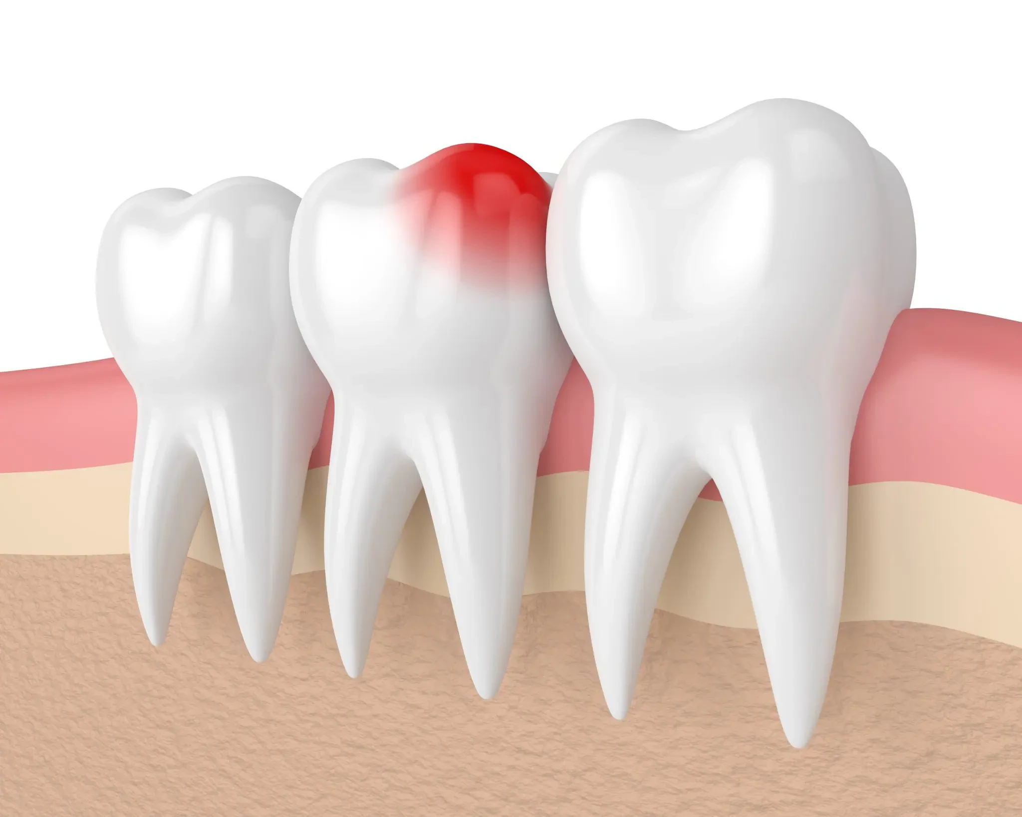 Nhổ răng khôn chưa bao giờ là khó với Amass Dental