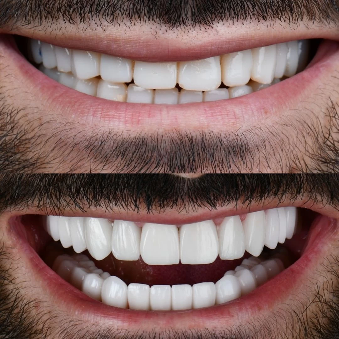 The reason why Western customers cannot ignore Amass dentistry when applying porcelain veneer.