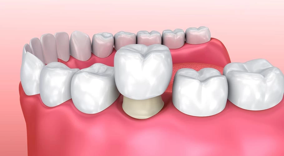 PORCELAIN VENEERS PROCEDURE