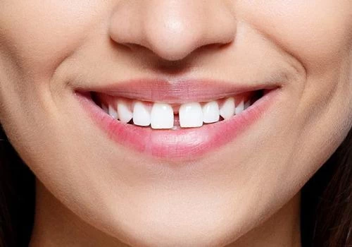 GAPPED FRONT TEETH: DOES IT BRING LOVE STRUGGLES OR LUCK?