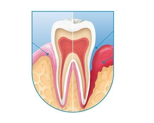 Viêm quanh cuống răng: Nguyên nhân và triệu chứng