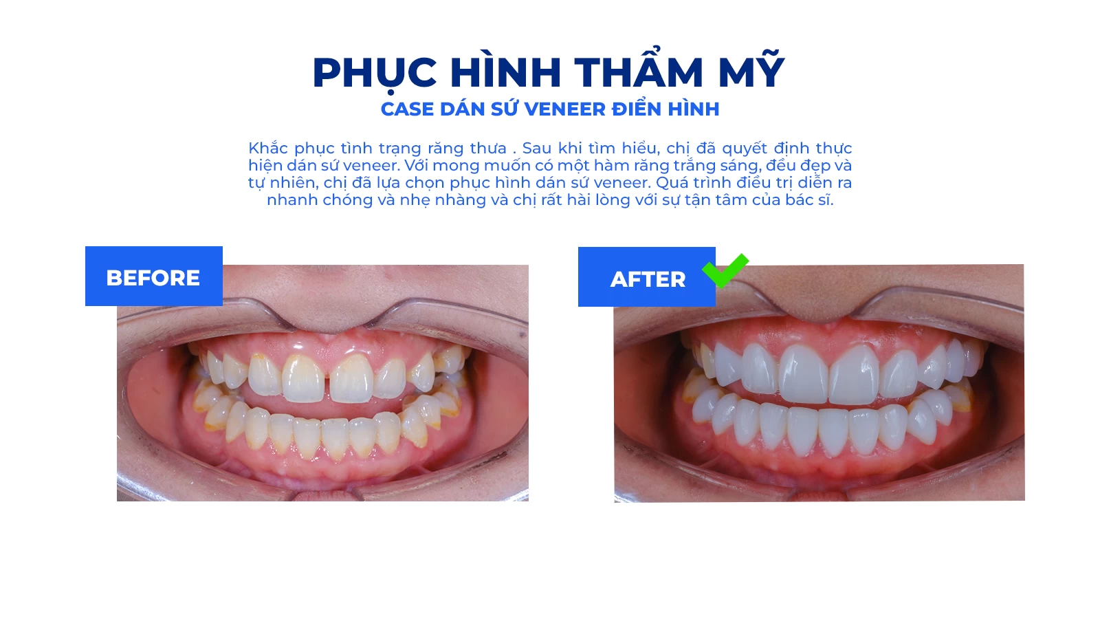 Chăm sóc răng miệng sau dán sứ Veneer